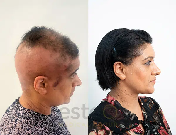 Alopecia before and after