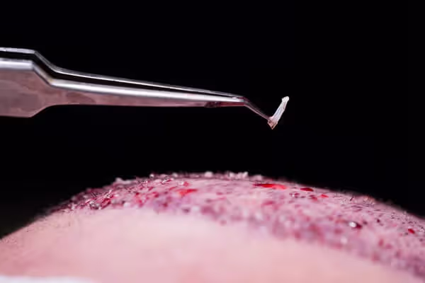 Hair Transplant: How Many Grafts?