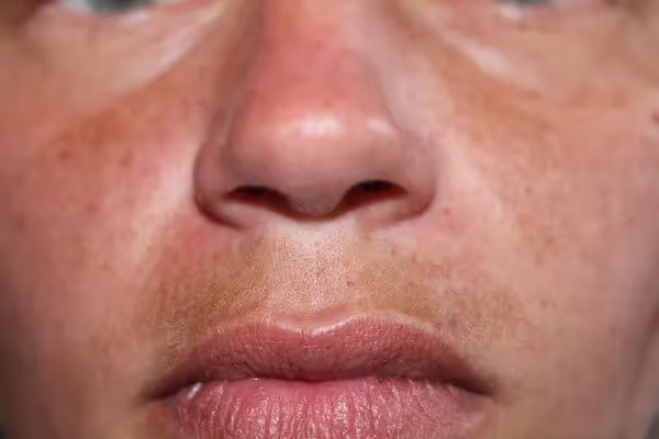 Melasma Mustache: How to Reverse Dark Upper Lip