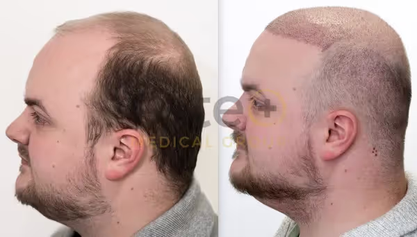 Adam's 3-Month Hair Transplant Results