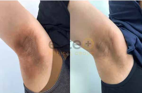 How To Lighten Armpit Pigmentation. Results of Underarm Peel
