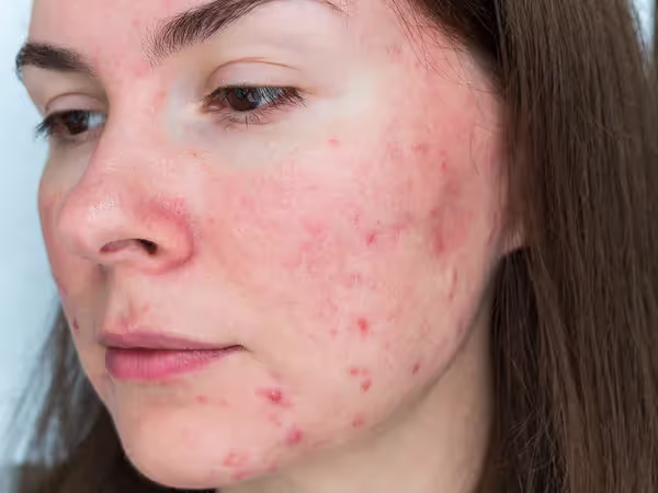 Can Rosacea Cause Facial Spider Veins? How To Treat This Red Face Skin Issue