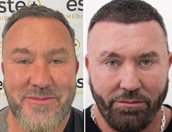 beard transplant before and after