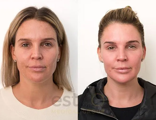 pigmentation before and after