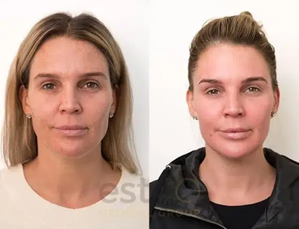 pigmentation before and after