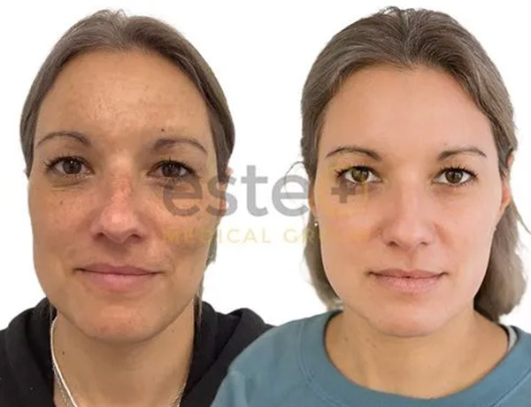 pigmentation before and after