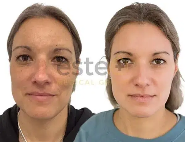 pigmentation before and after