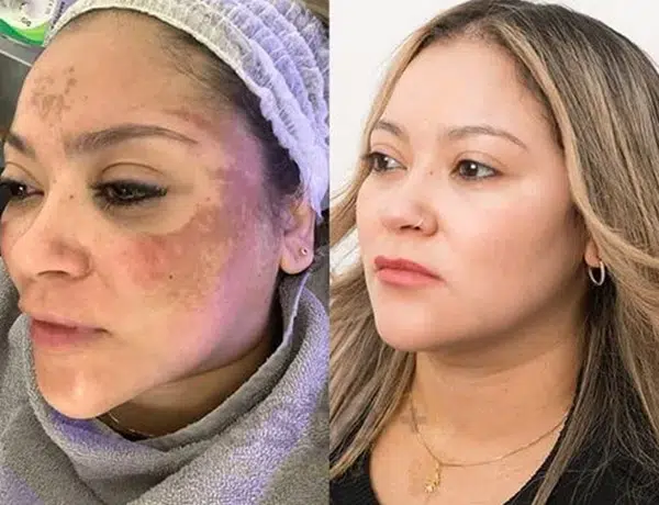 pigmentation before and after