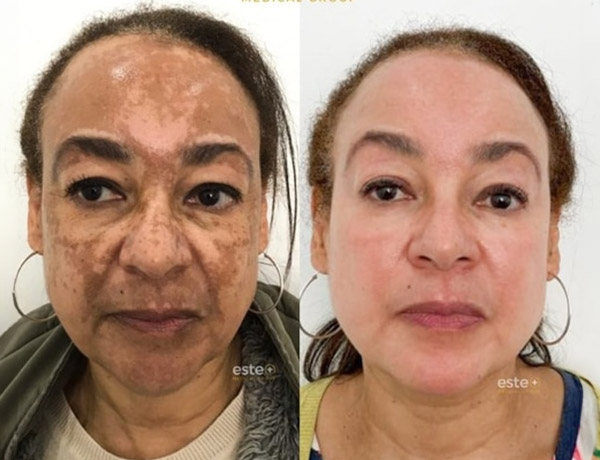 pigmentation before and after