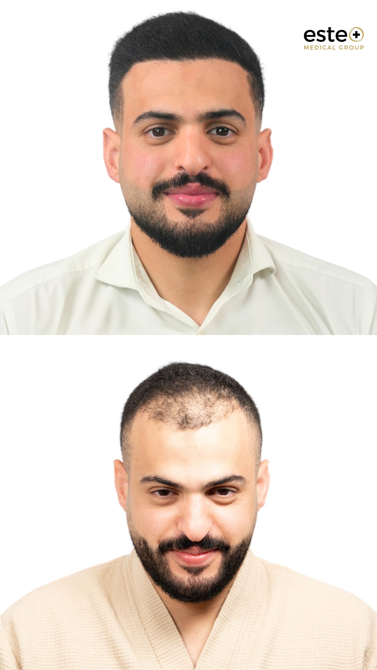 Robotic DHI hair transplant before and after results