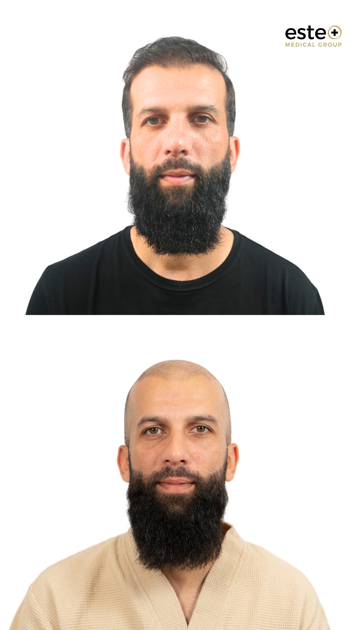 Hairline restoration before and after (hair transplant)