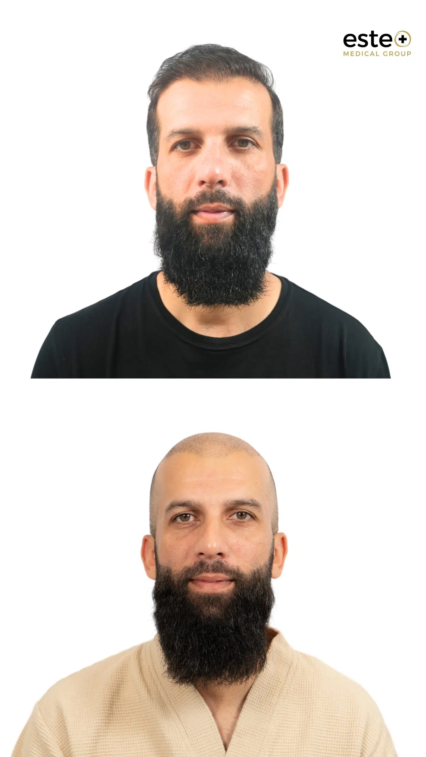 Hairline restoration before and after (hair transplant)