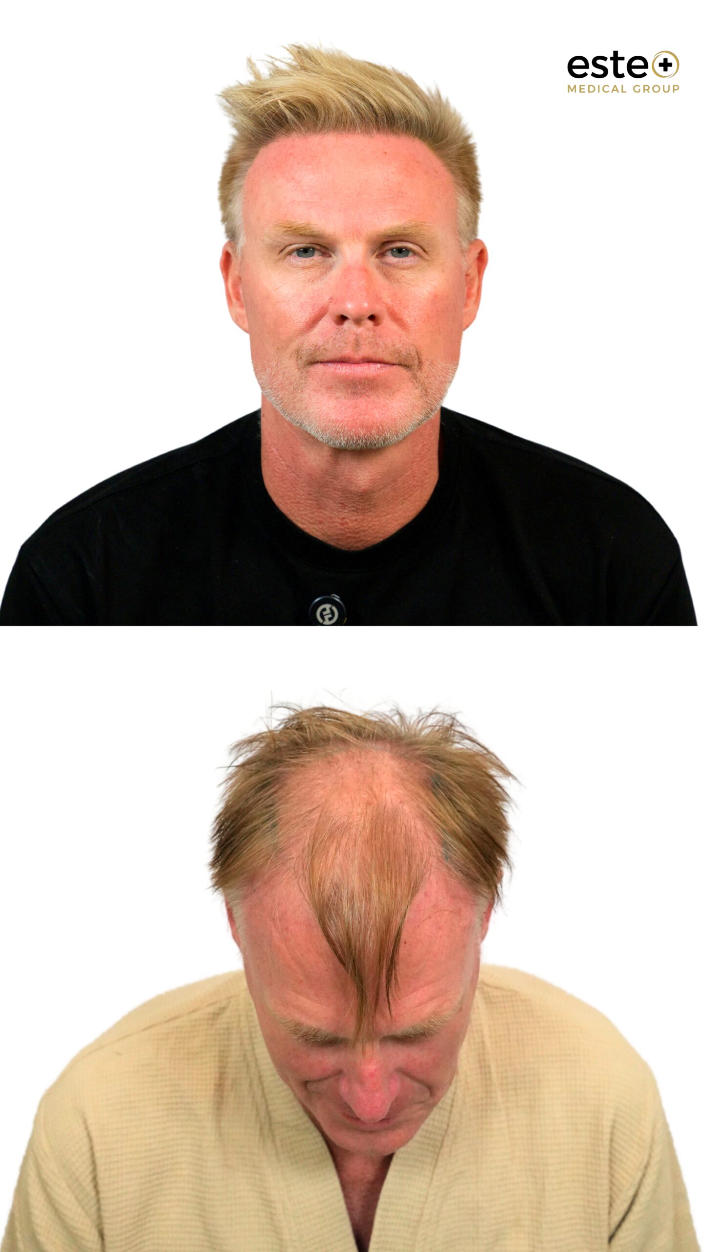 Hair transplant results before and after