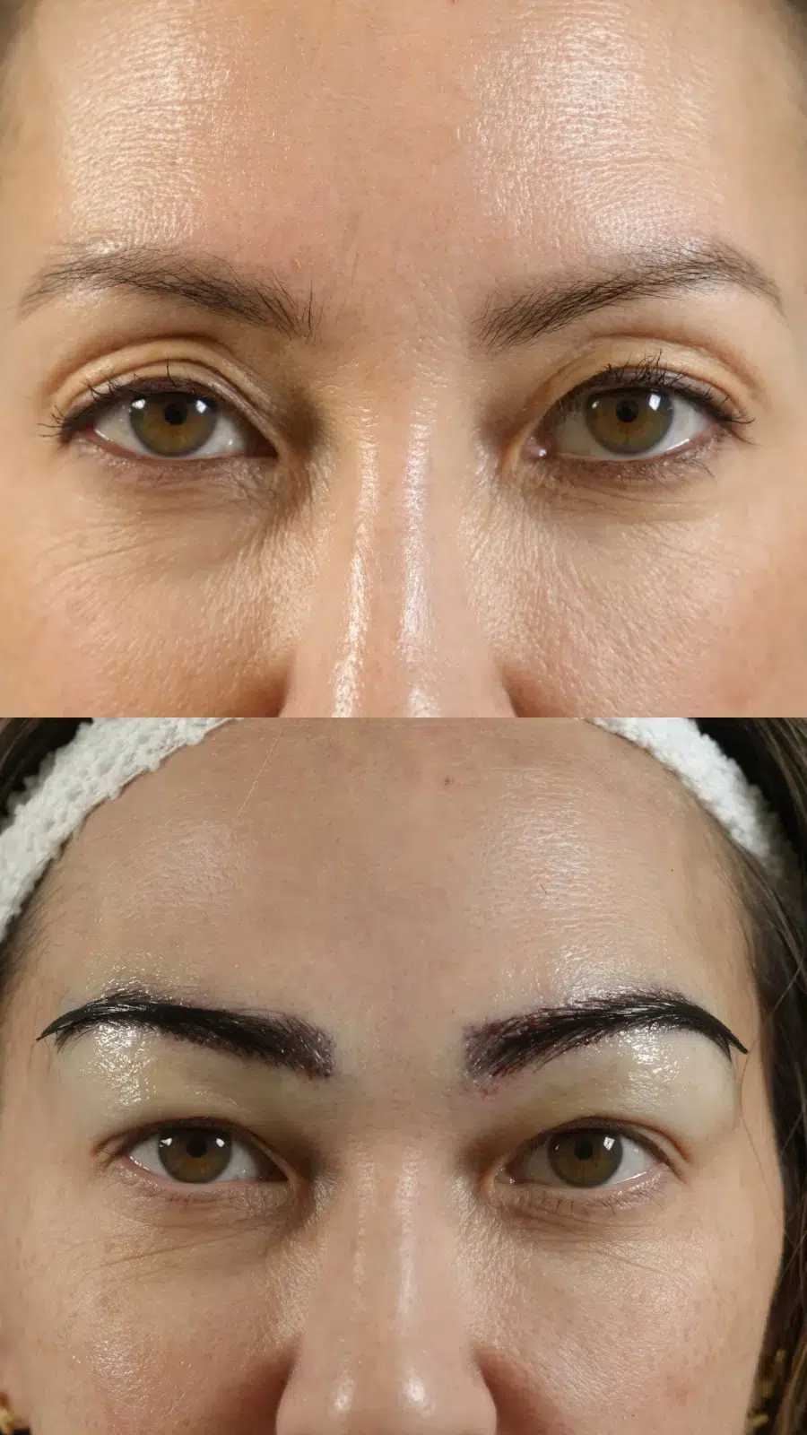 Eyebrow Hair Transplant before and after