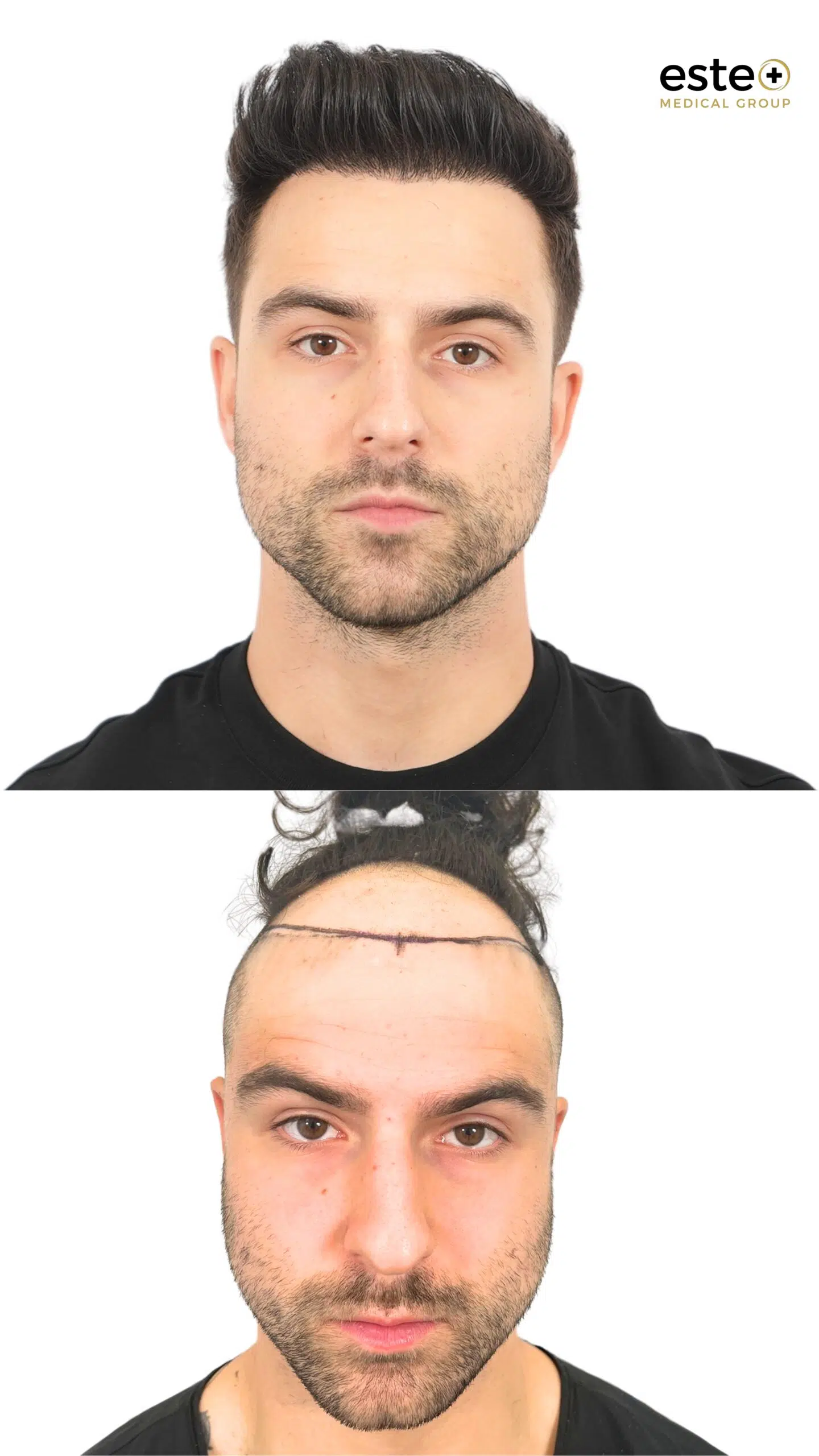 Hair transplant before and after photos