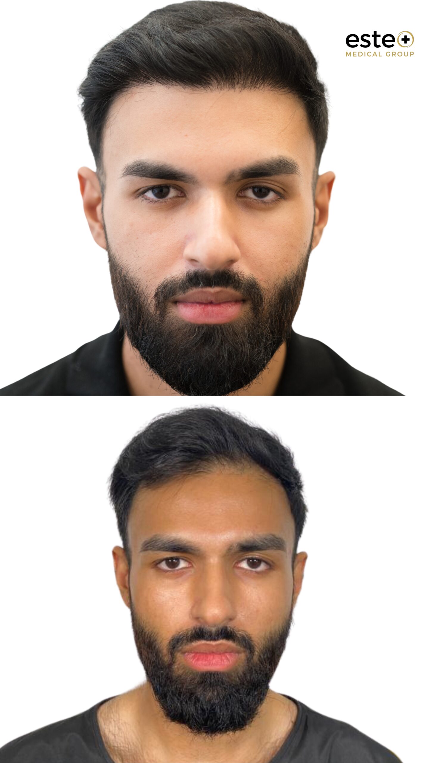 Hair transplant before and after results for thinning hair