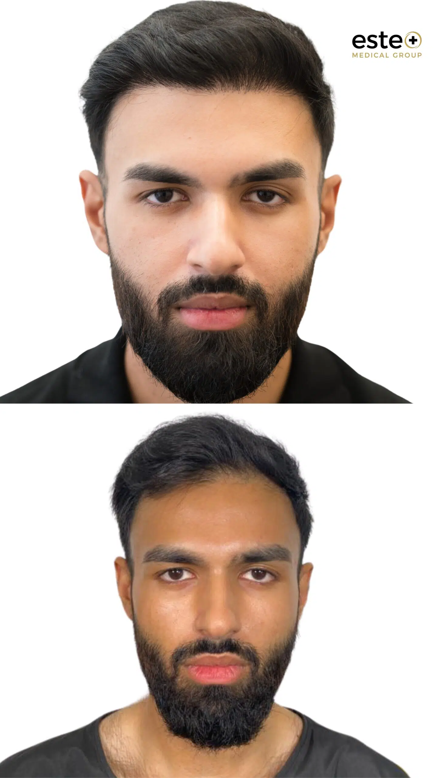 Hair transplant before and after results for thinning hair