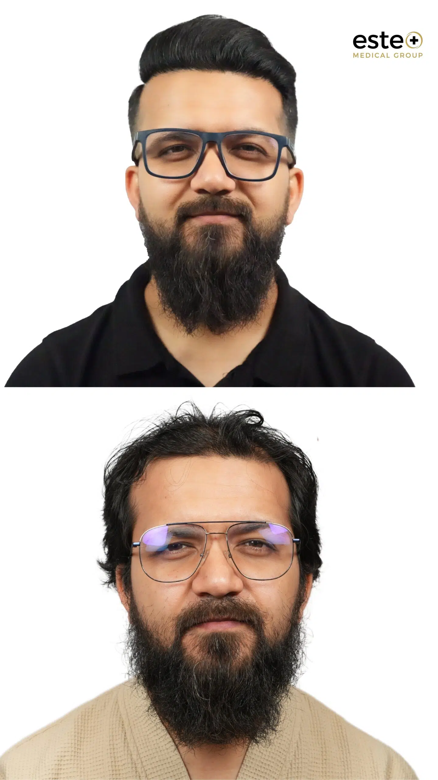 Hair transplant before and after results for receding hairline