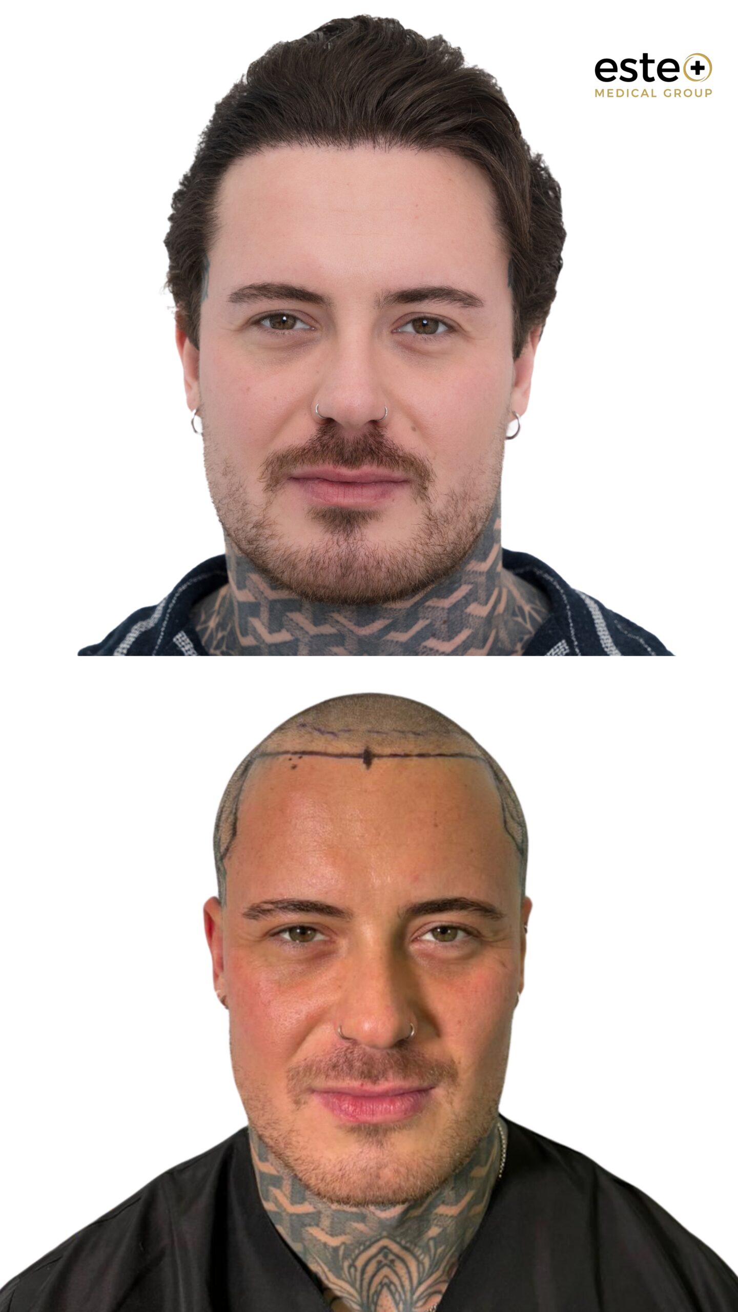 Hair transplant before and after results