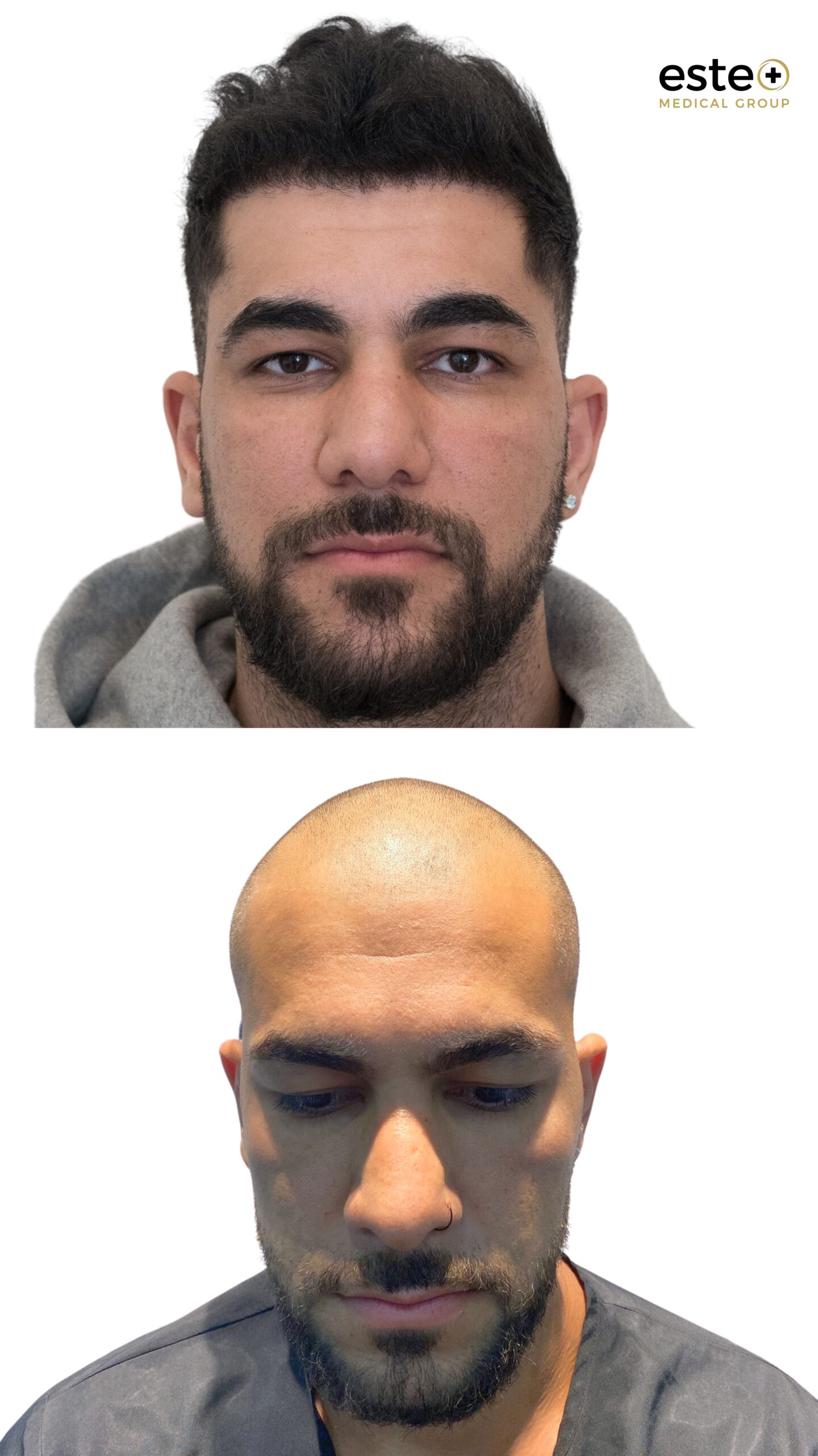 Hair transplant before and after results (natural-looking hairline)