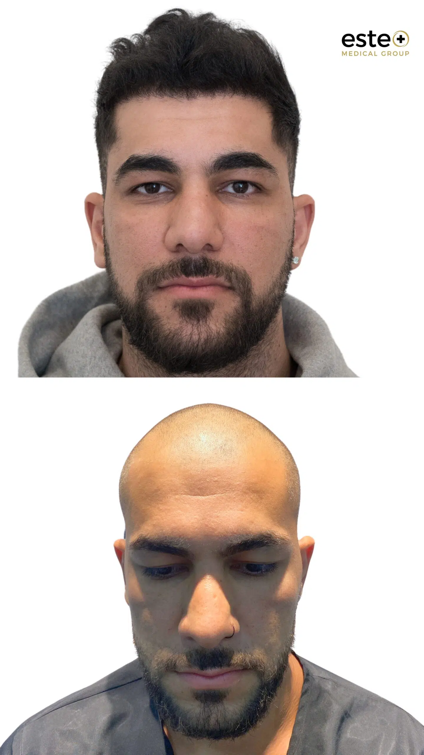 Hair transplant before and after results (natural-looking hairline)