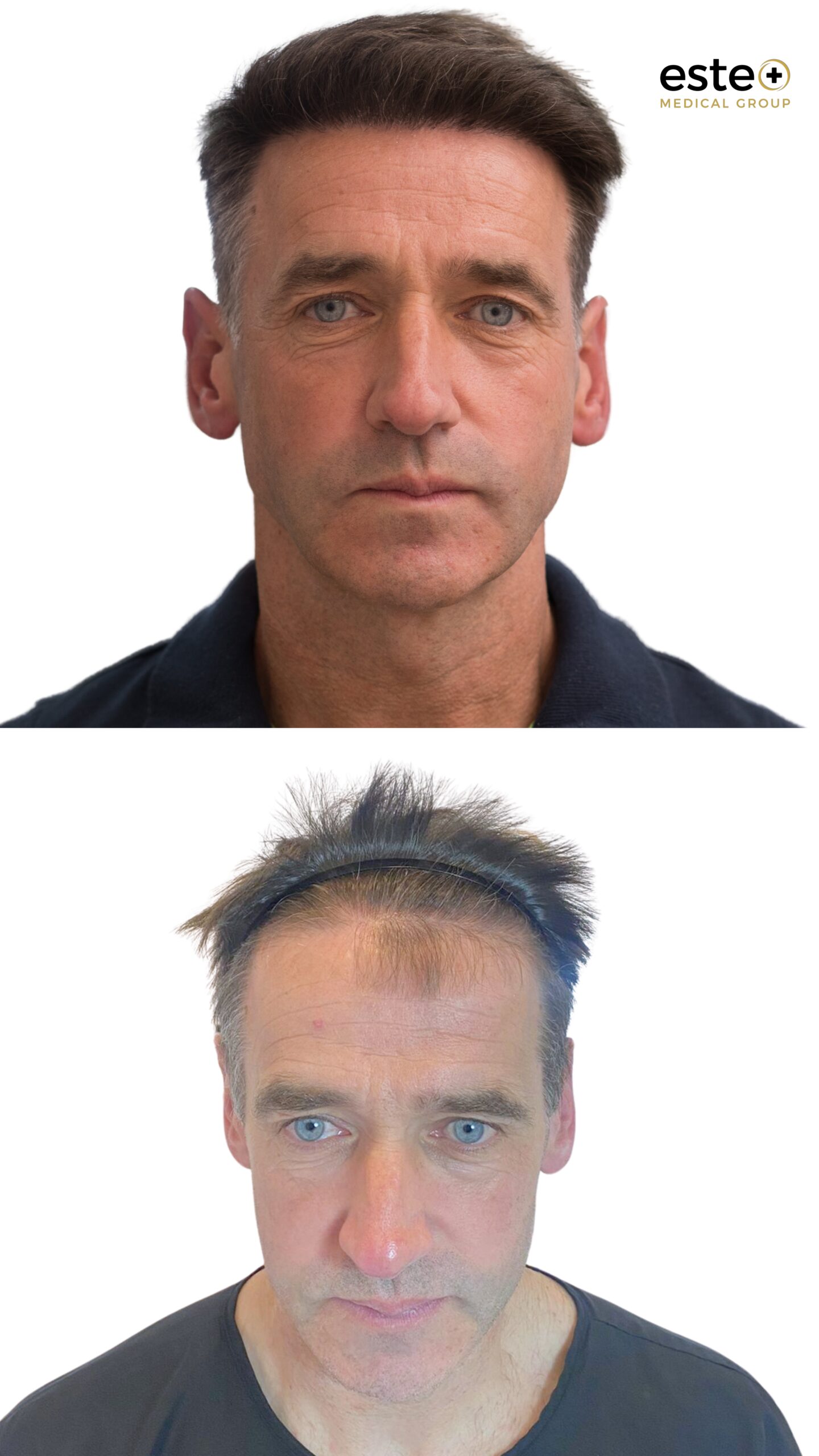 Robotic DHI hair transplant before and after comparison