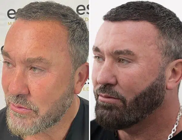 beard transplant before and after