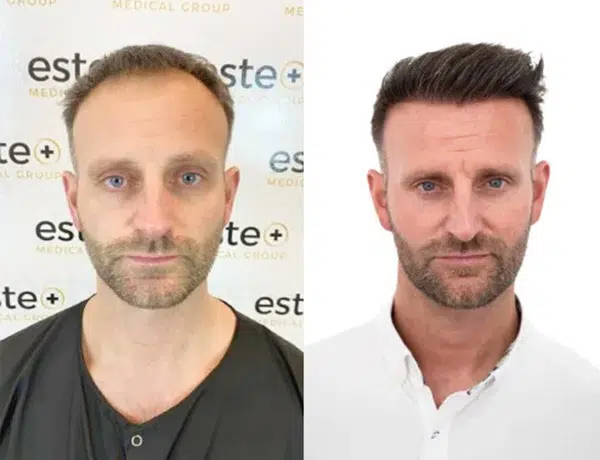 Before and after result