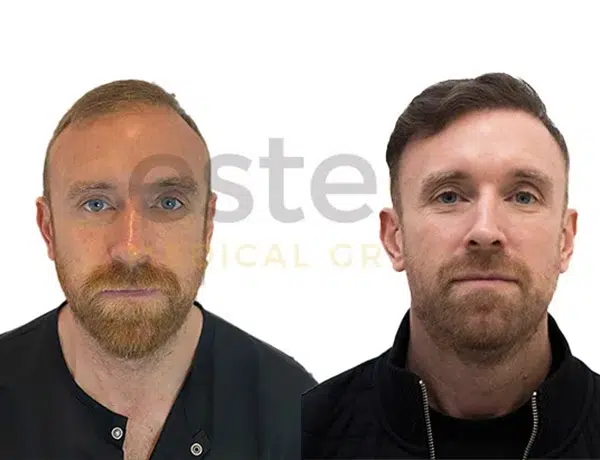 Before and after result