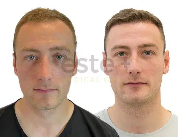 Before and after result