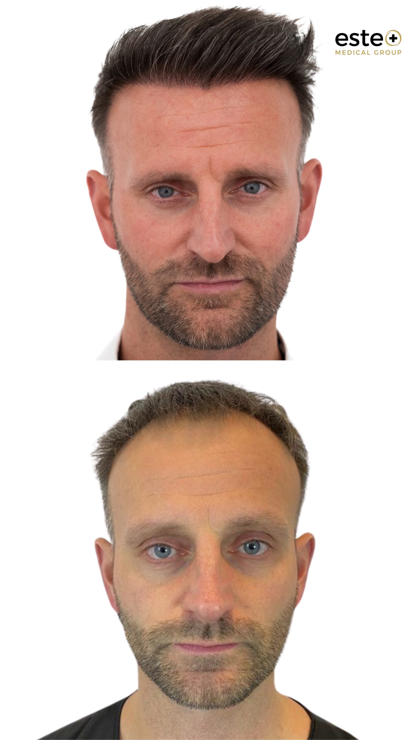 Hair transplant before and after results (improved coverage)