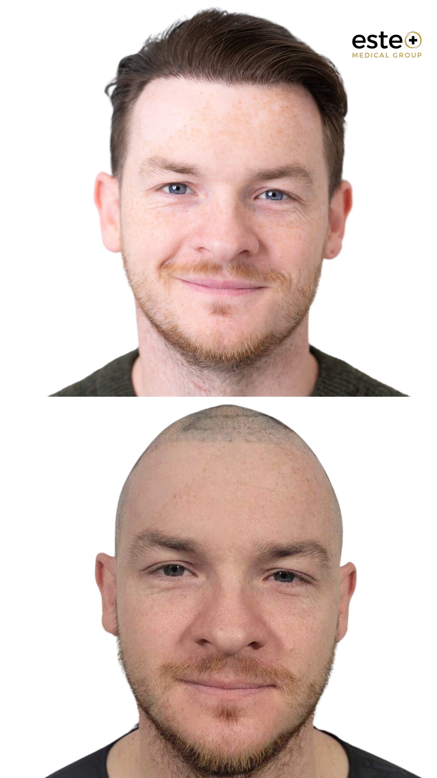 Hair transplant before and after results (visible regrowth)
