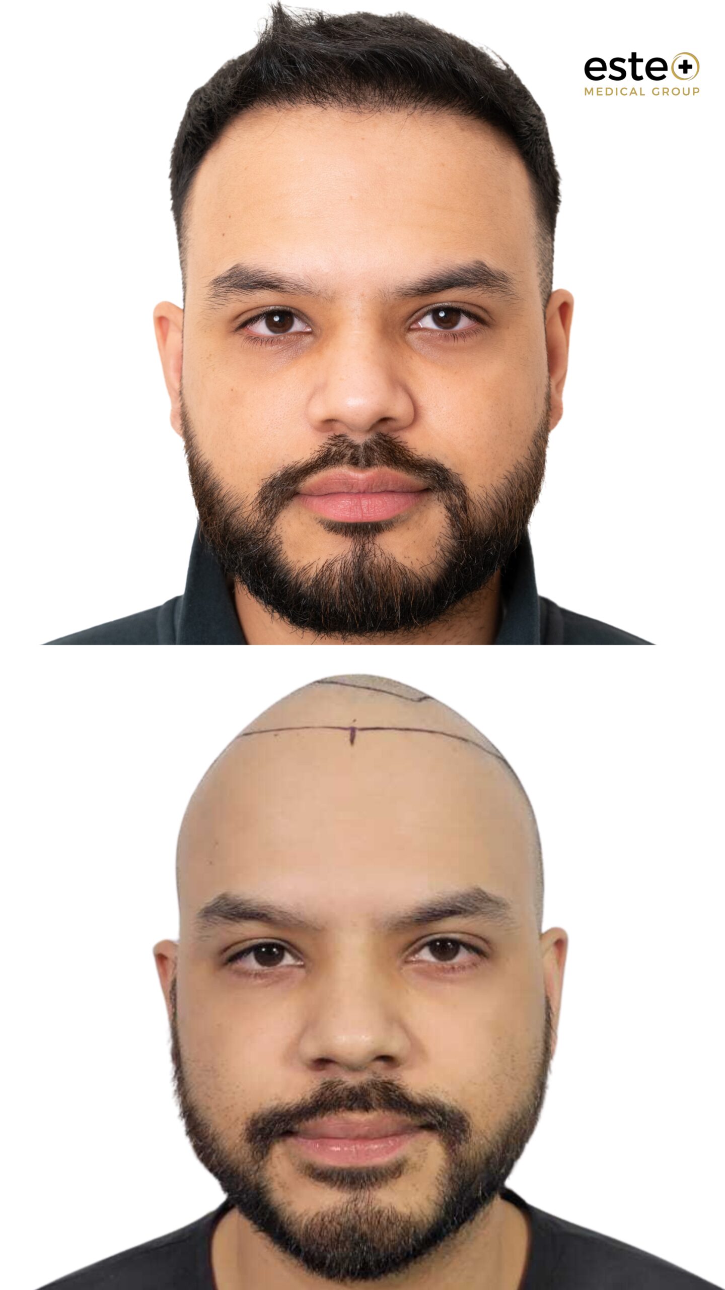 Hair transplant before and after results (patient outcome)