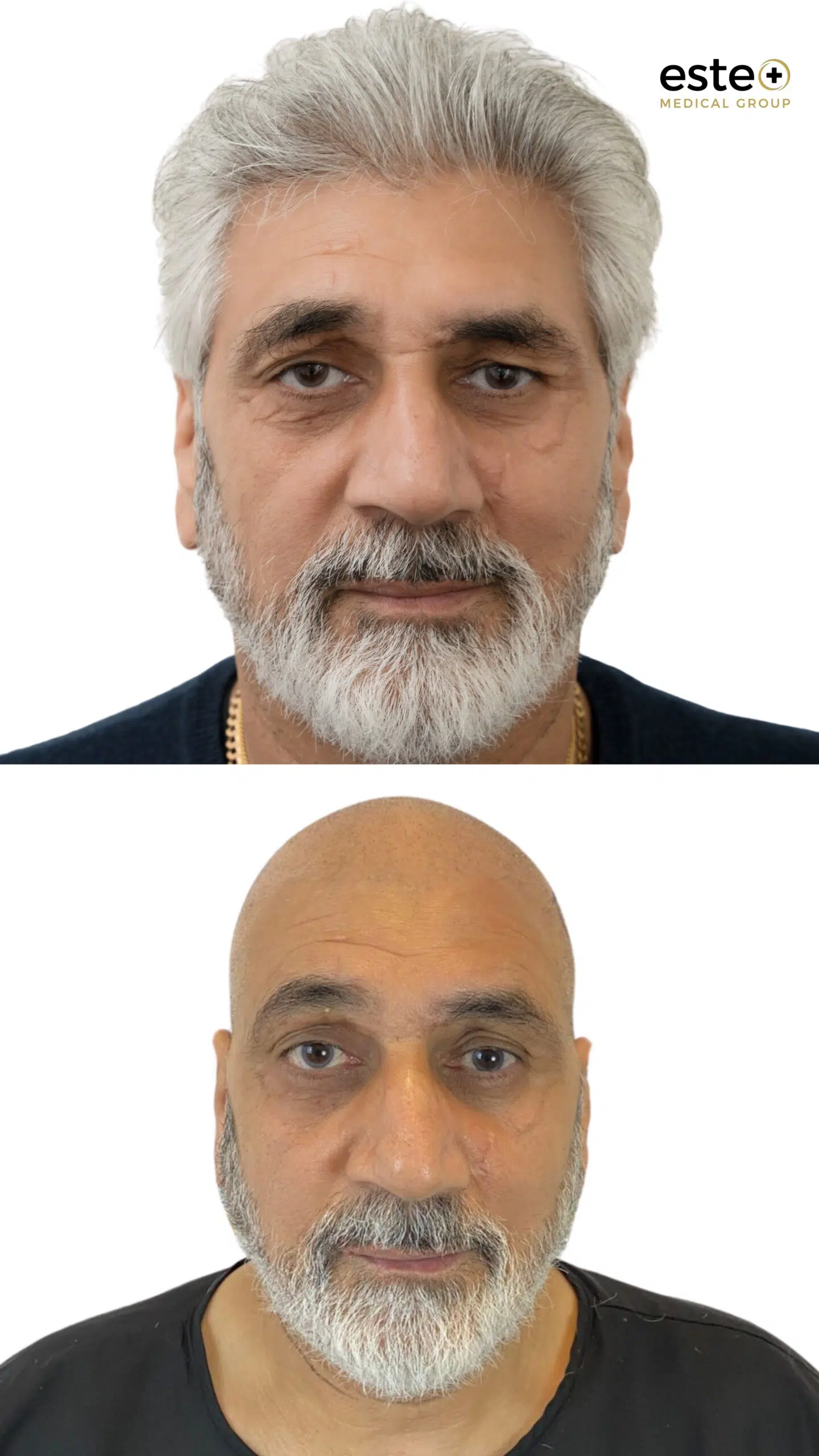 Hair transplant before and after photos (UK results)