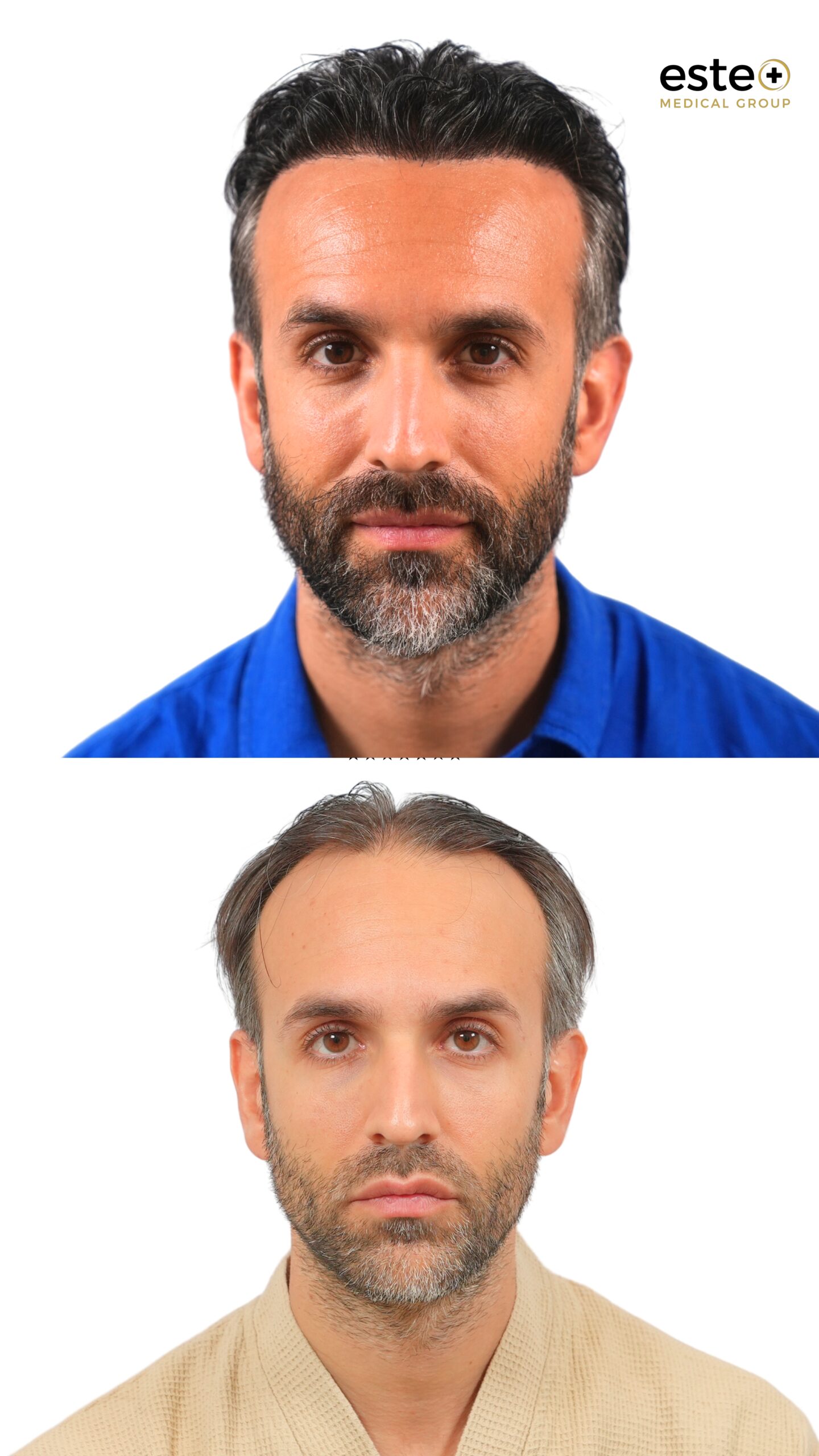 Hair transplant before and after photos
