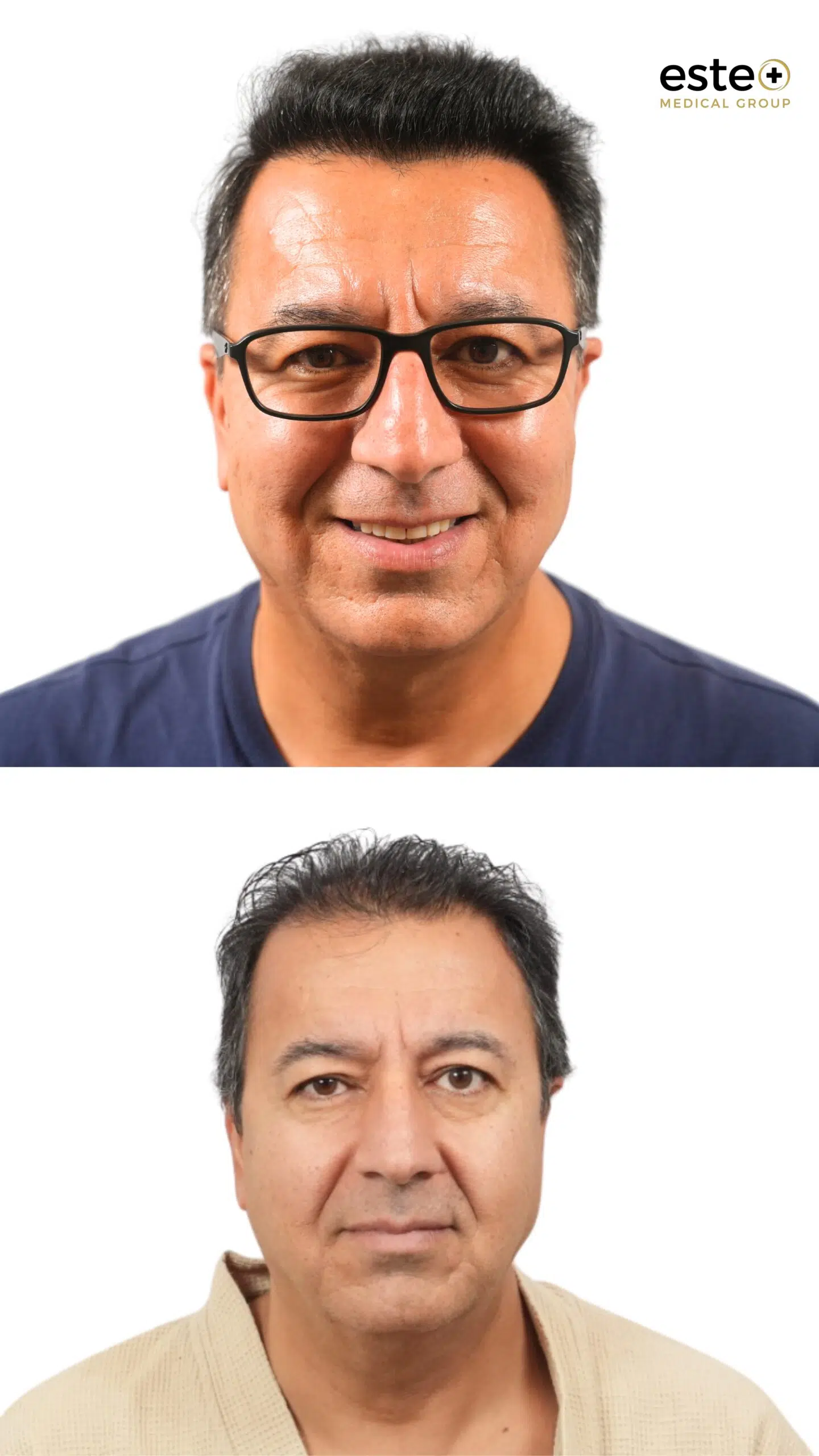 Robotic DHI hair transplant before and after photos