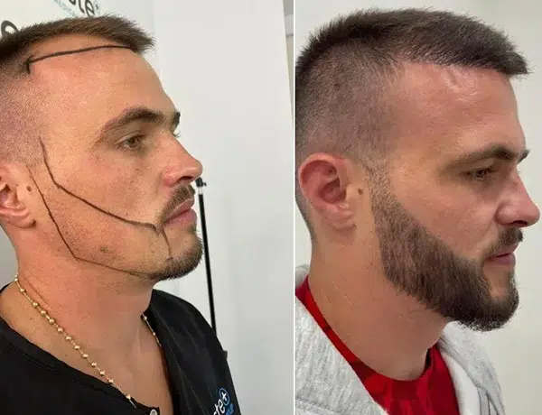 beard transplant before and after