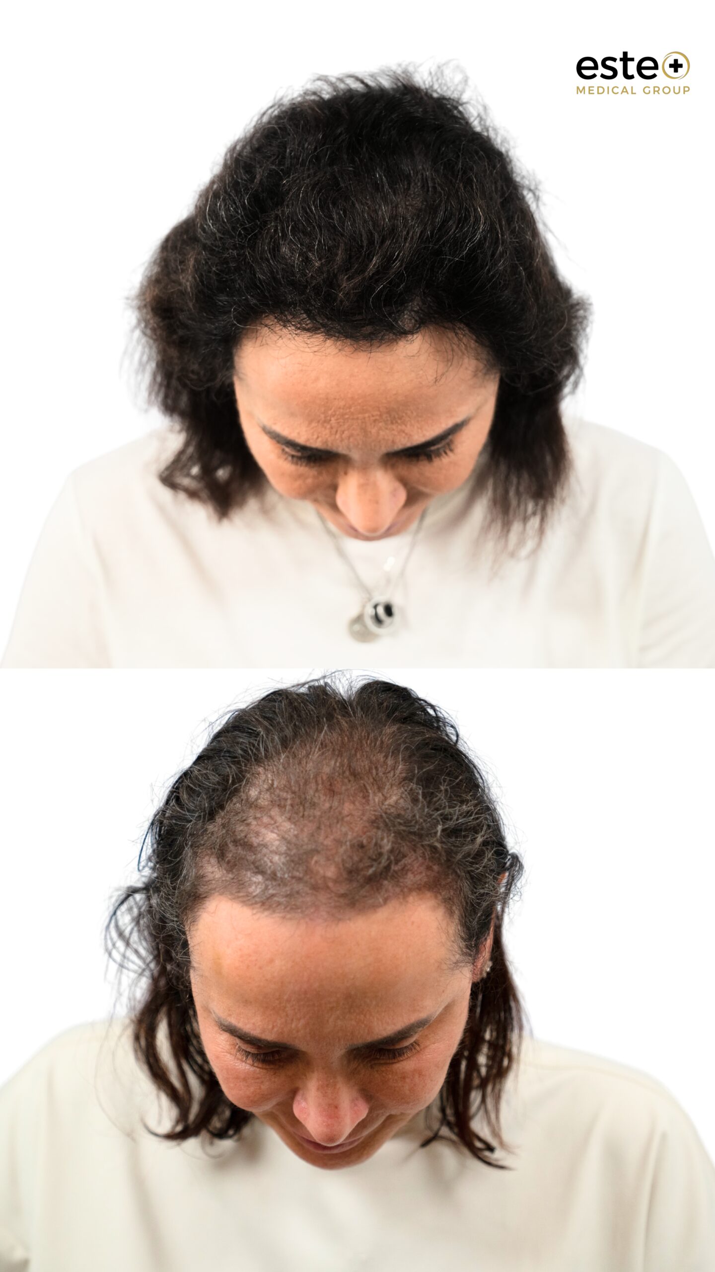 Hair transplant before and after photos