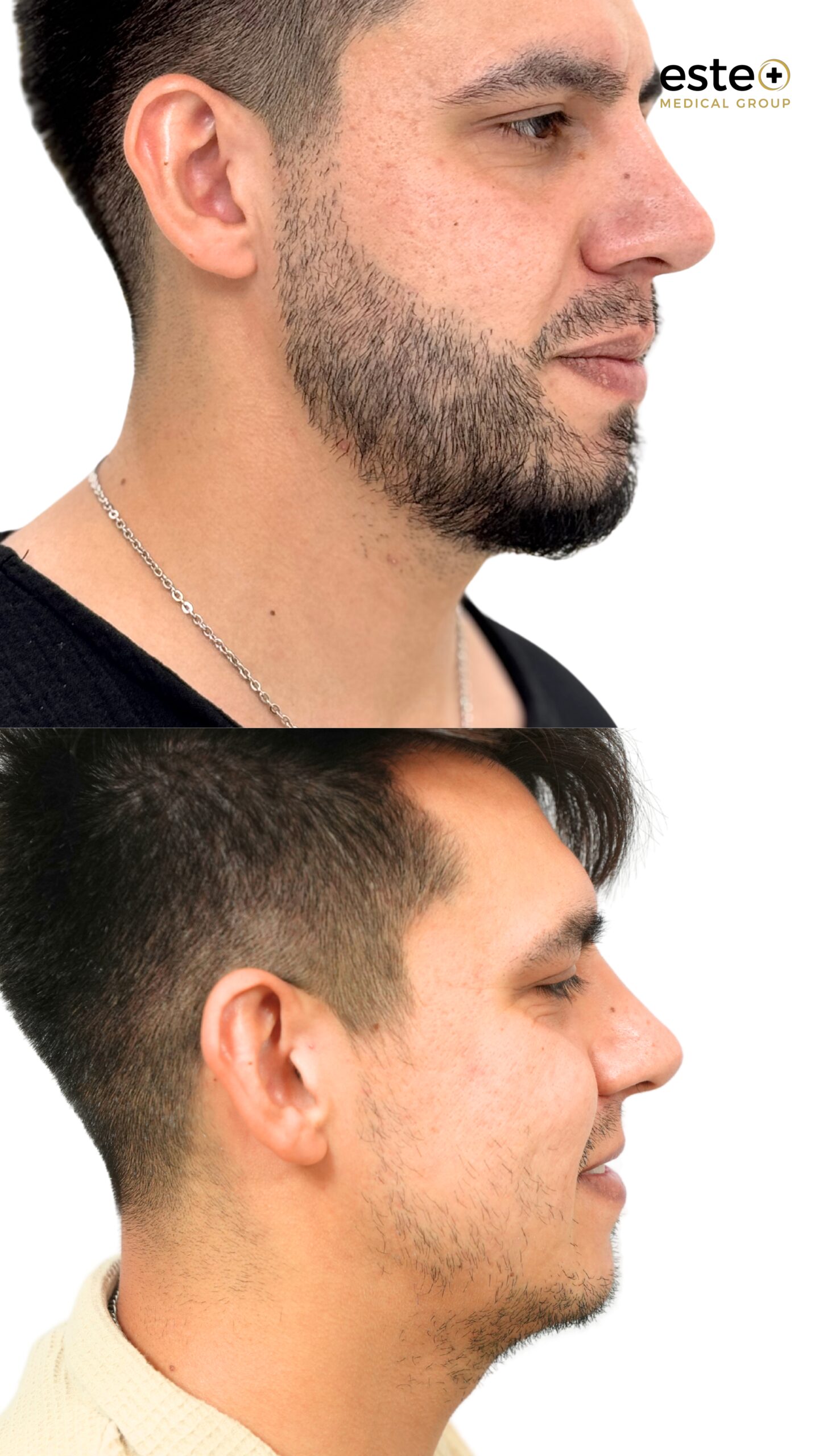 Hair transplant before and after results (visible regrowth)