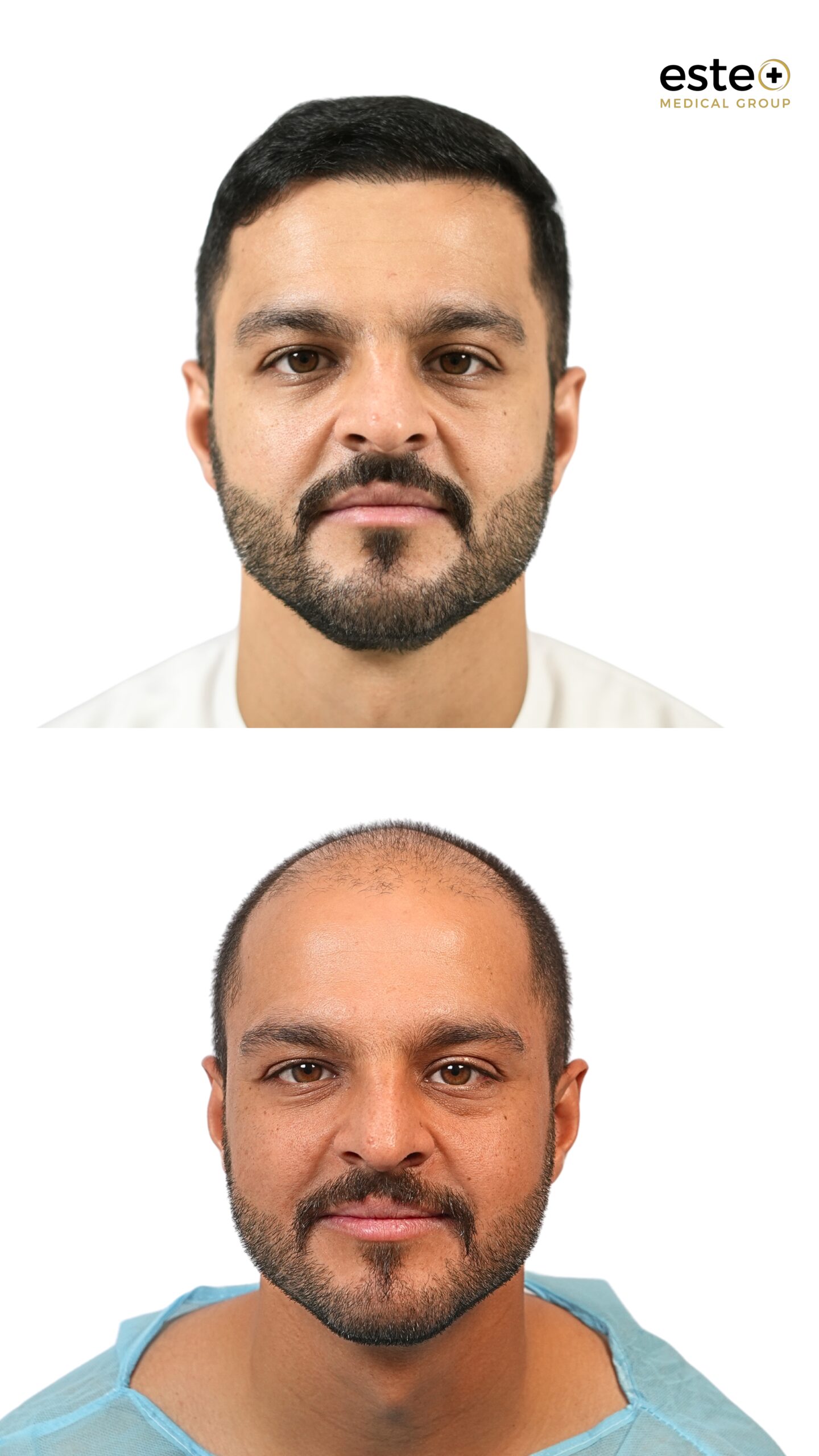 Hair transplant results before and after
