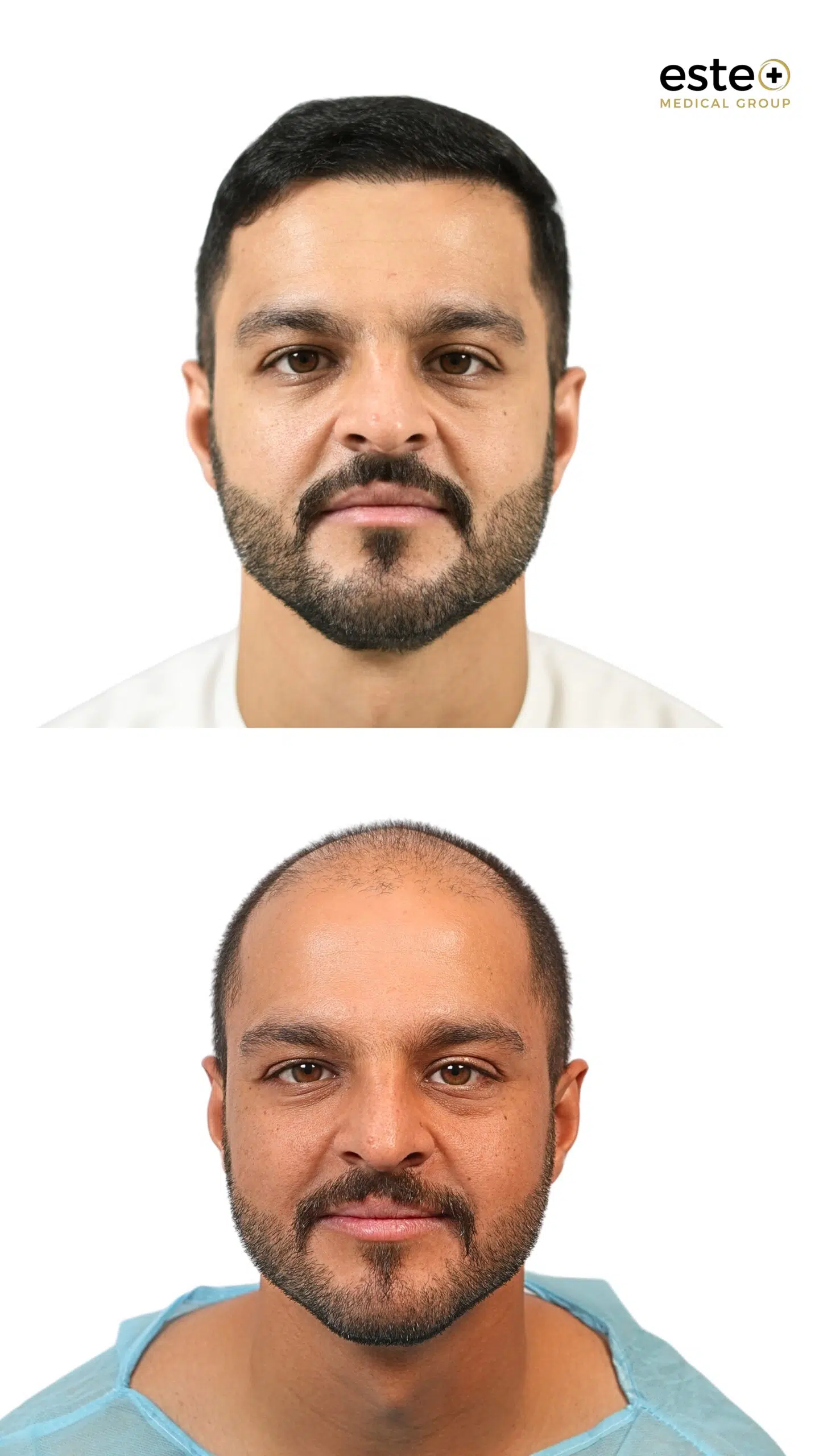 Hair transplant results before and after