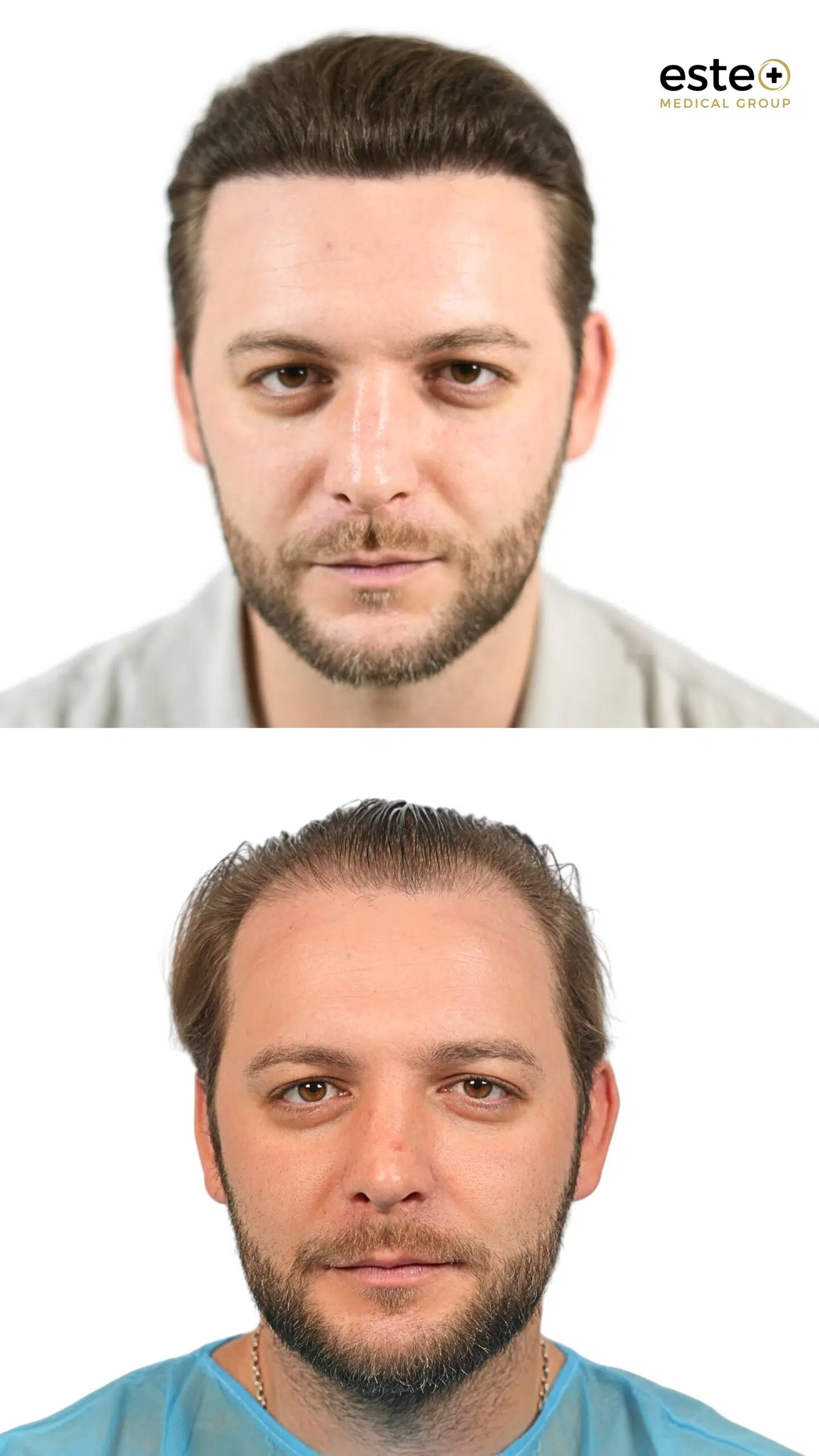 Robotic DHI hair transplant before and after comparison