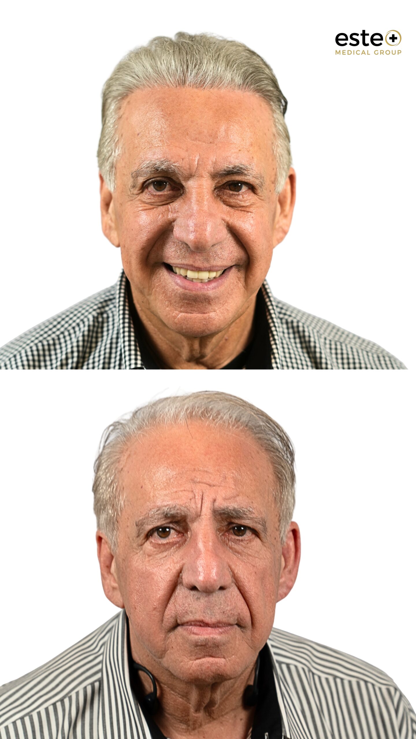 Hair transplant before and after results (visible regrowth)