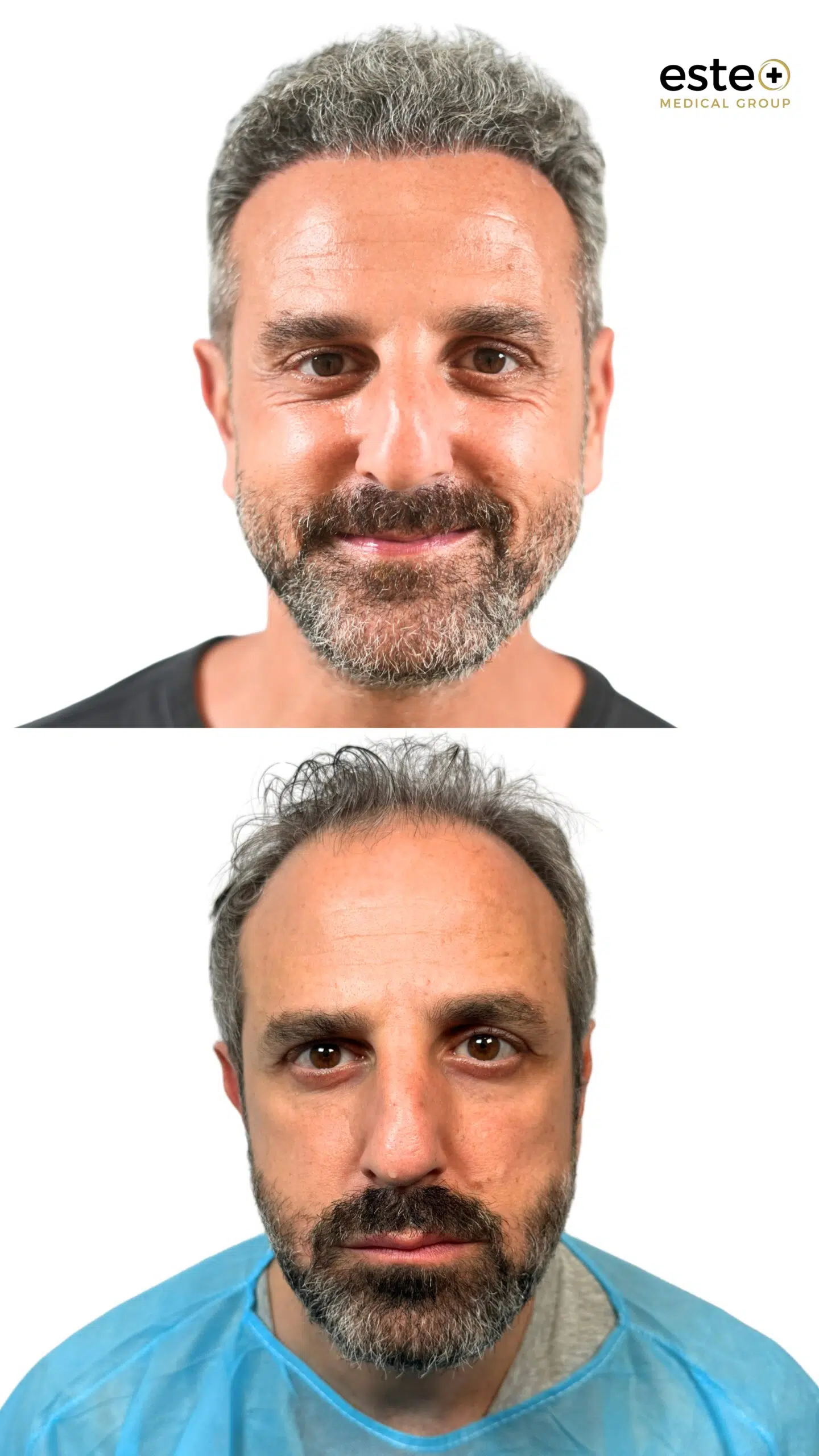 Hair transplant before and after results (visible regrowth)