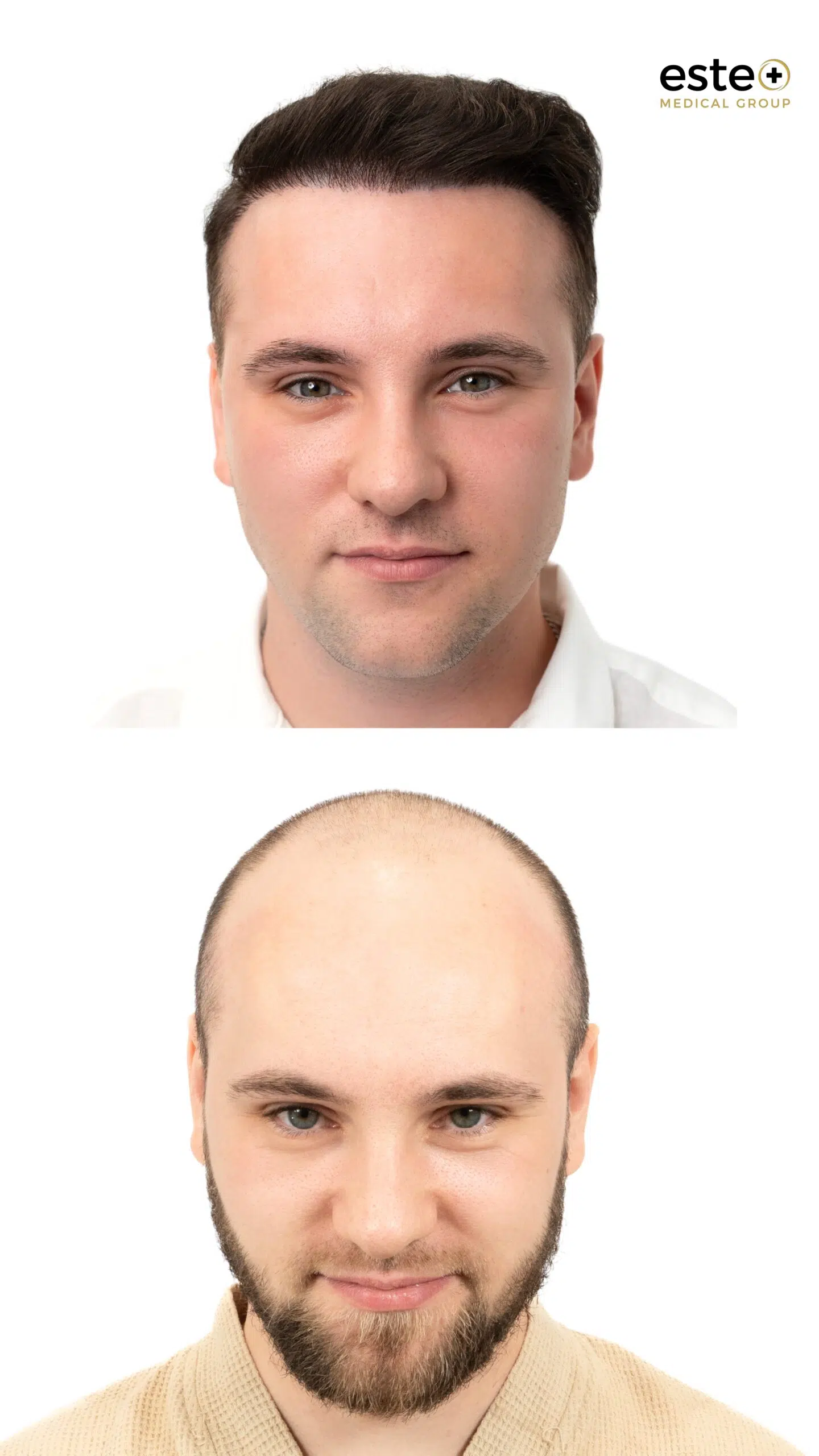 Hair transplant before and after results for thinning hair