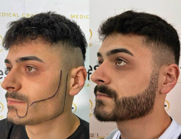 beard transplant before and after