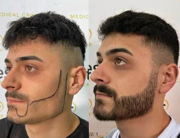 beard transplant before and after
