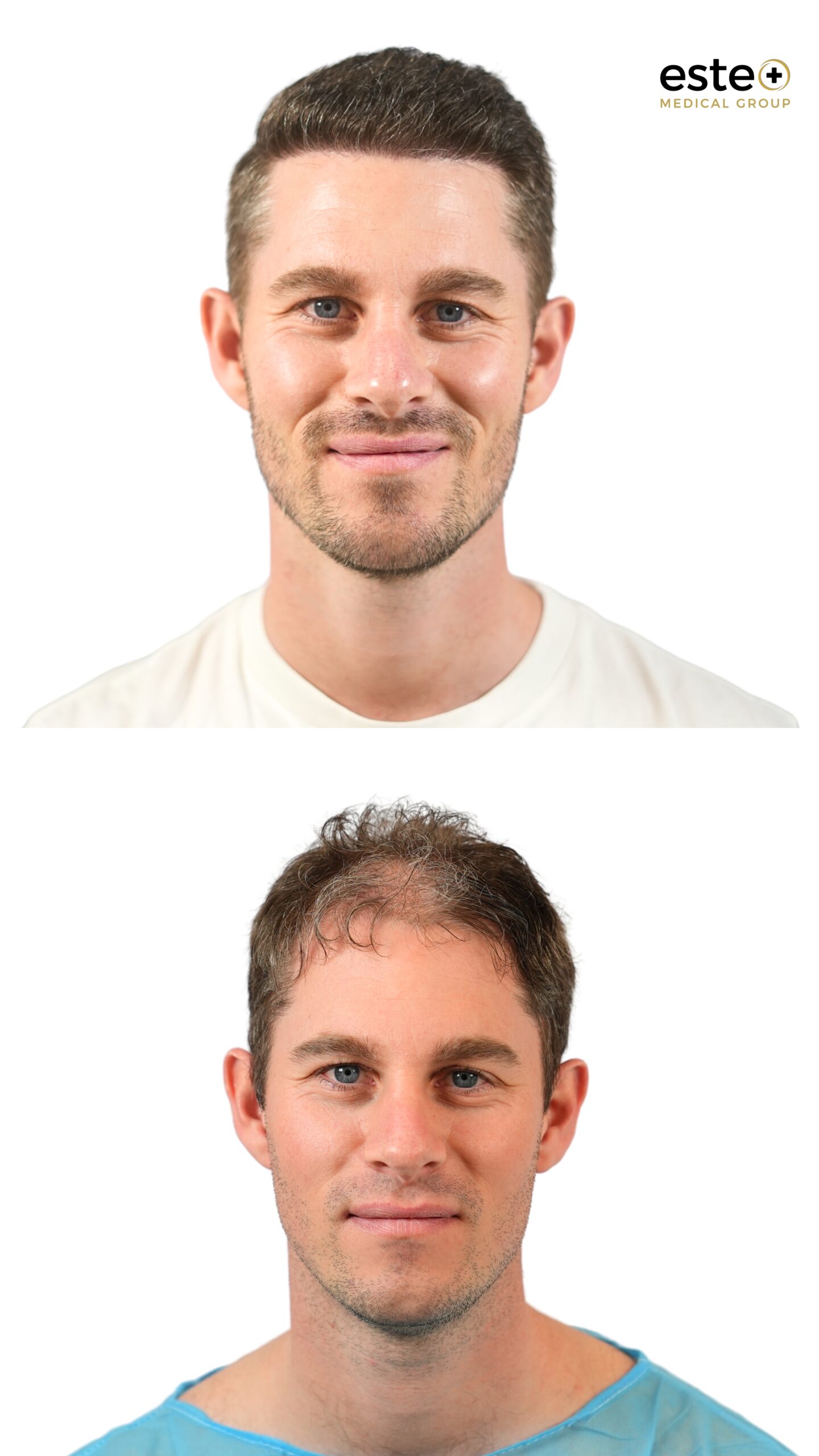 Hair transplant before and after results (visible regrowth)