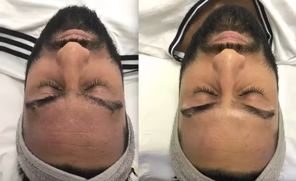 Bye-Bye Eczema! Anja & Omraj’s Successful LED Skincare Treatment