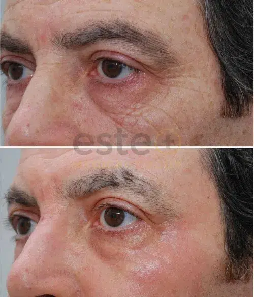 Non Surgical Facelift